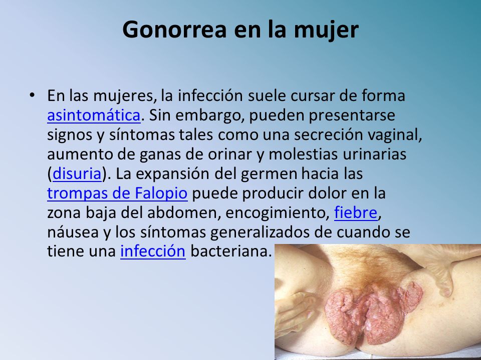 que es la uretritis gonocócica